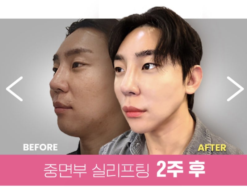 韓国 糸リフト 男性中顔面リフティング 施術2週間後のビフォーアフター