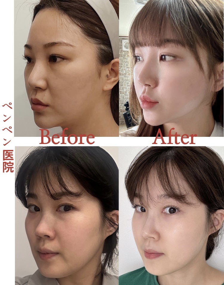 韓国 糸 リフトで自然なフェイスラインを実現した症例｜ペンペンクリニック
