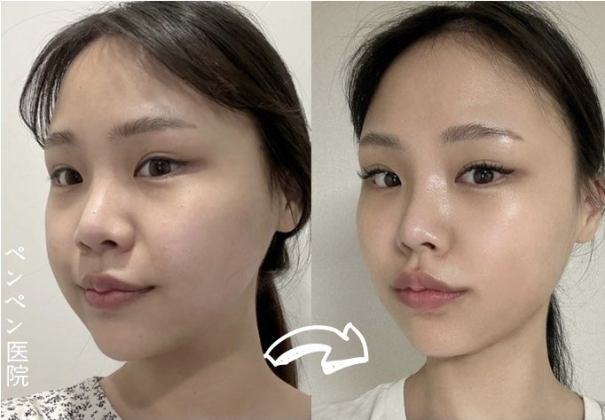 韓国 糸 リフトで美しいフェイスラインになった女性のビフォーアフター｜ペンペンクリニック