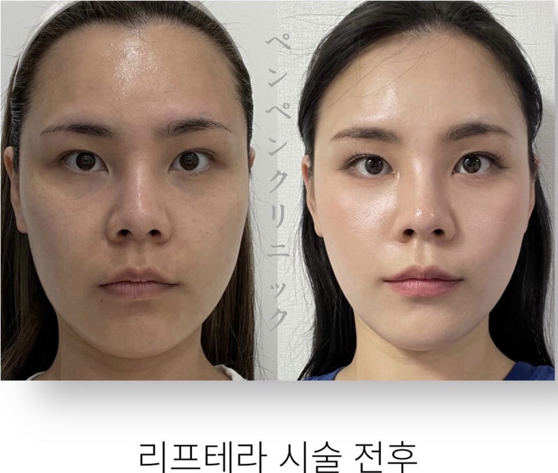 韓国美容クリニックで人気の糸リフト、ペンペンクリニックのビフォーアフター（リフテラ施術）
