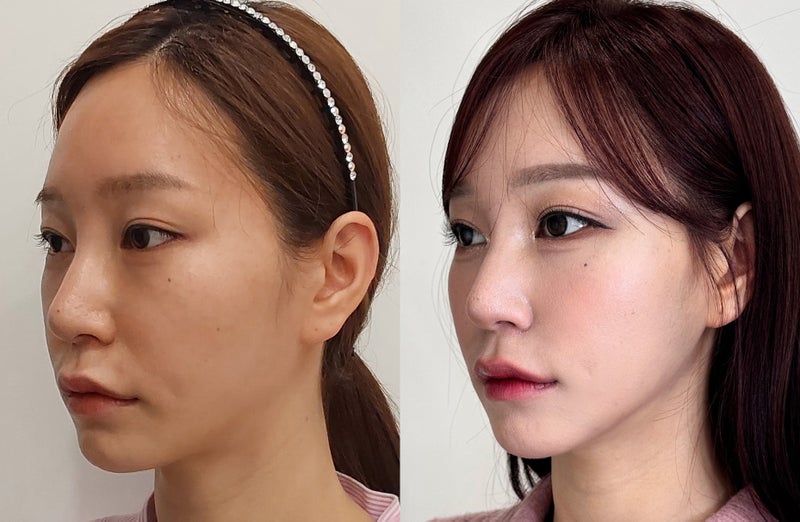 韓国 糸リフトで中顔面をリフトアップしたビフォーアフター写真