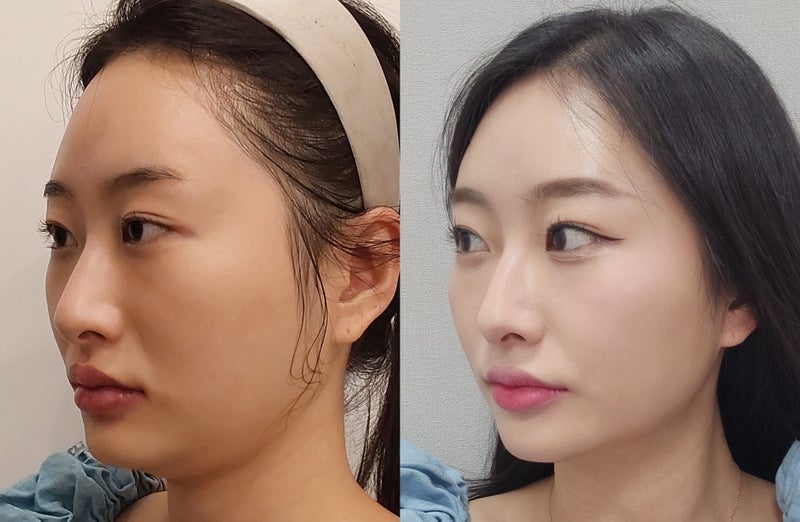 韓国 糸リフトでフェイスラインを引き締めた症例写真（施術前後）