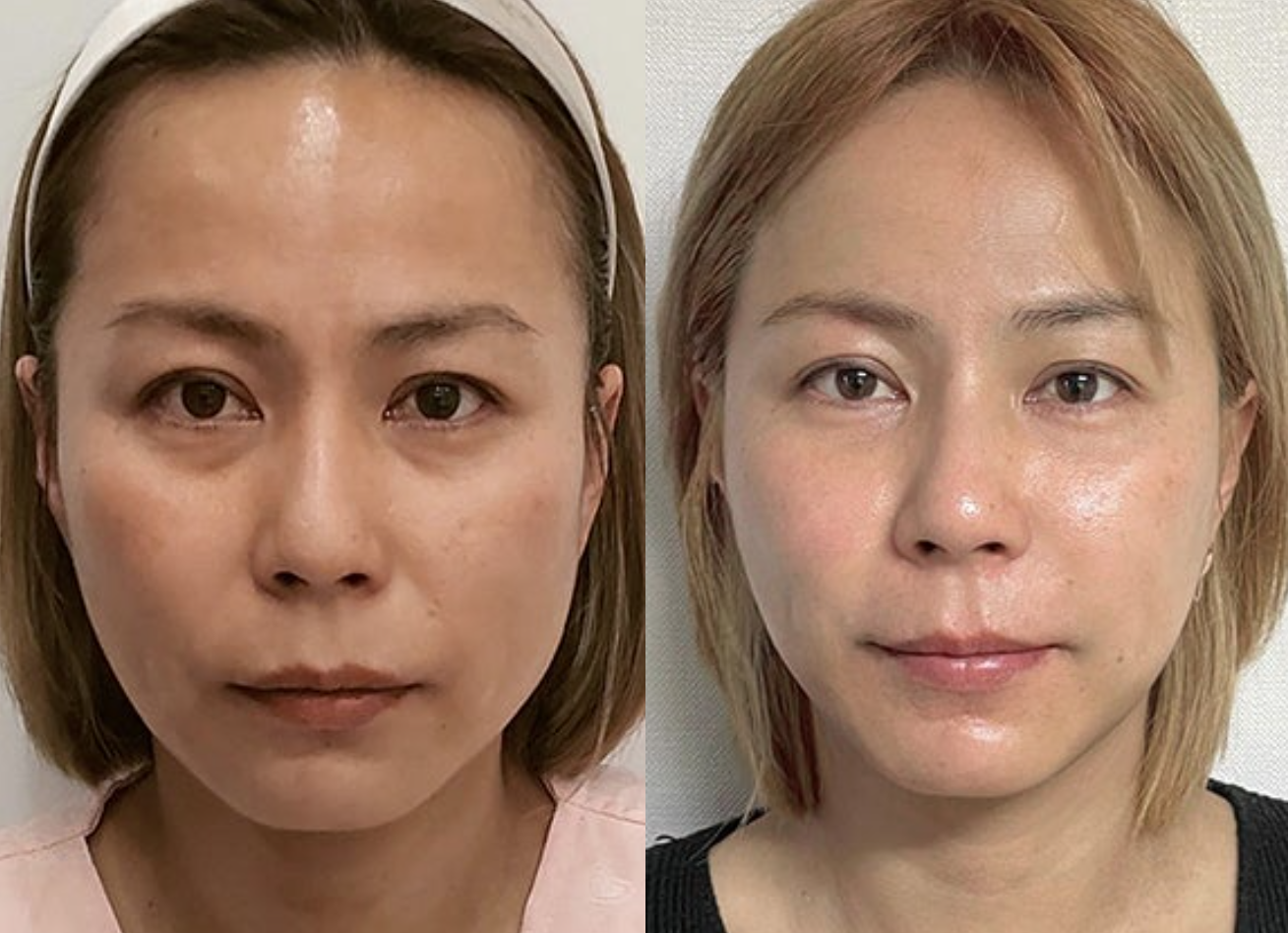 韓国 糸リフトで中顔面のたるみを改善した症例写真