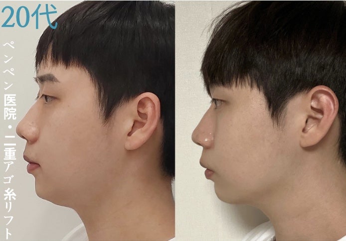 韓国 糸 リフトで自然な二重アゴが改善された20代男性の症例｜ペンペンクリニック