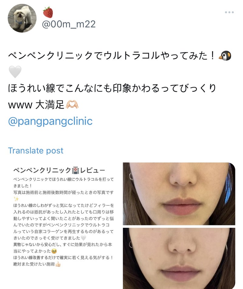 韓国 糸リフト ほうれい線改善 ウルトラコル施術レビュー