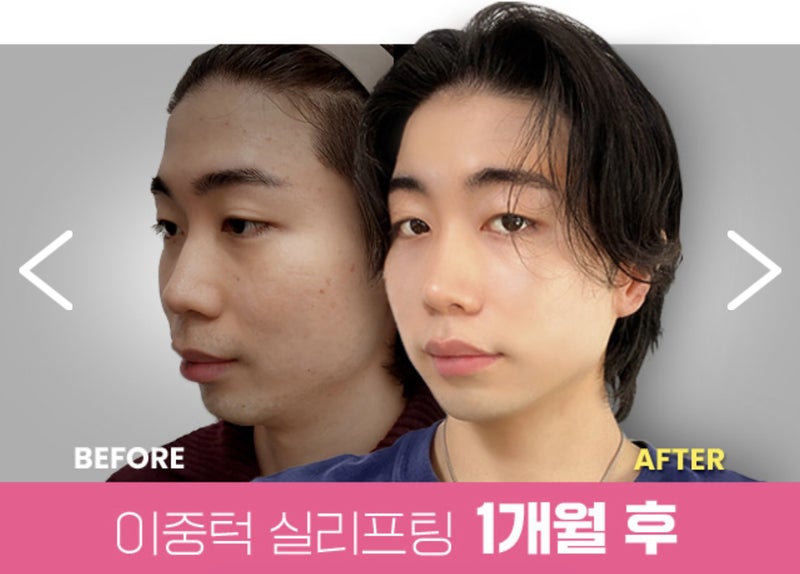 男性の二重あご糸リフティング施術ビフォーアフター（1ヶ月後）