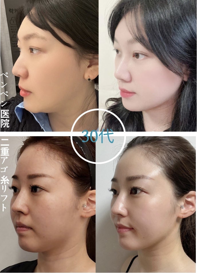 韓国 糸 リフトで若々しいフェイスラインになった30代女性の症例｜ペンペンクリニック