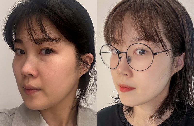 韓国 糸リフト症例｜自然な若返りを実現したビフォーアフター