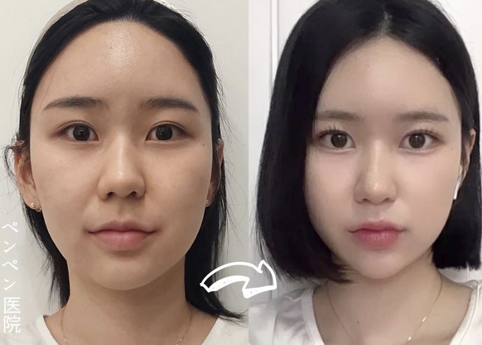 韓国 糸 リフトで自然なフェイスラインになった女性のビフォーアフター｜ペンペンクリニック