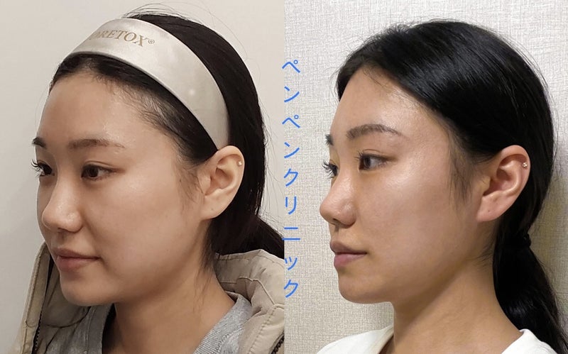 韓国で糸リフト施術中の様子｜丁寧なカウンセリングで人気のペンペンクリニック