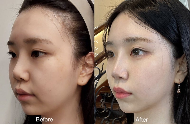 韓国 糸 リフトでフェイスラインがすっきりした症例｜ペンペンクリニック