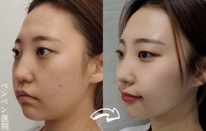 韓国 糸 リフトで自然な美しさを取り戻した女性のビフォーアフター｜ペンペンクリニック