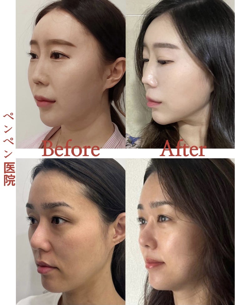 韓国 糸 リフトで自然な美しさを叶えたビフォーアフター｜ペンペンクリニック