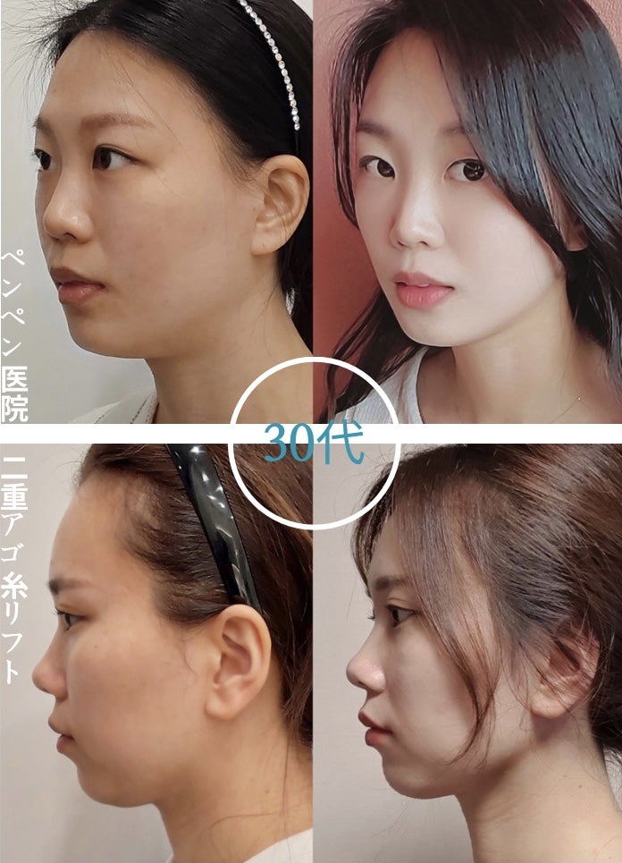 韓国 糸 リフトでフェイスラインが引き締まった30代女性の症例｜ペンペンクリニック