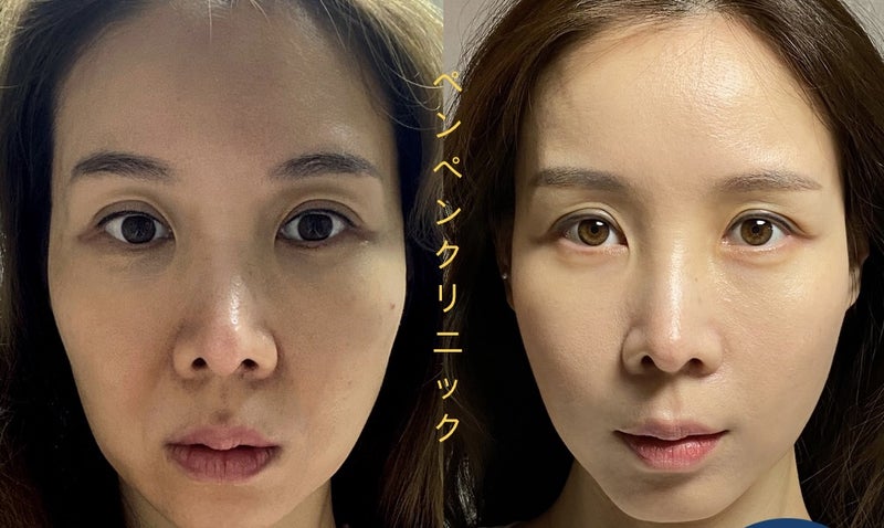 韓国 糸 リフトで若々しい印象に変化したペンペンクリニックのビフォーアフター写真