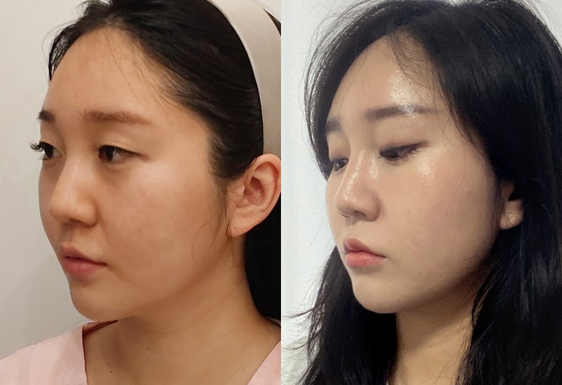 韓国 糸リフトでフェイスライン改善｜女性のビフォーアフター症例