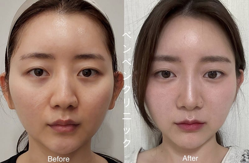 韓国 糸 リフトで小顔になったビフォーアフター｜ペンペンクリニックの美容症例