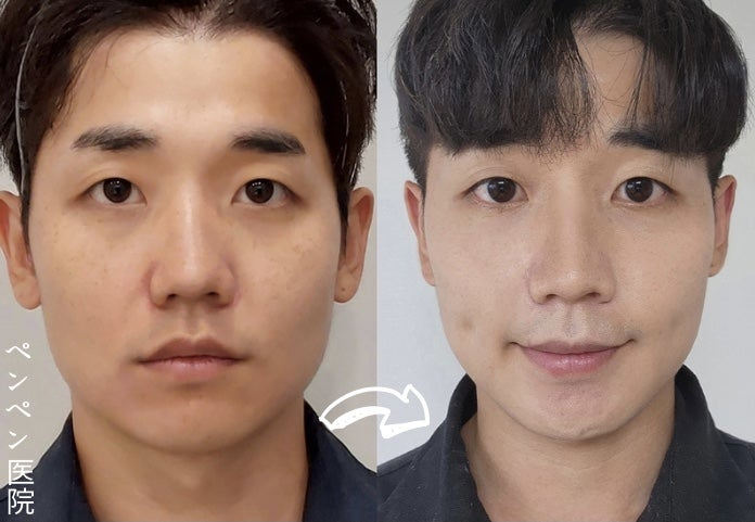 韓国 糸 リフトで若返り効果を実感した男性のビフォーアフター｜ペンペンクリニック