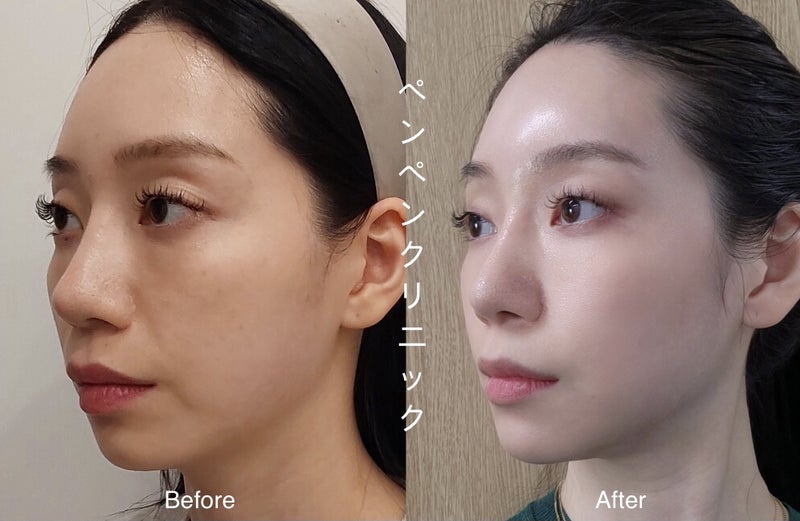韓国 糸 リフトで自然なVラインを実現した美容症例｜ペンペンクリニック