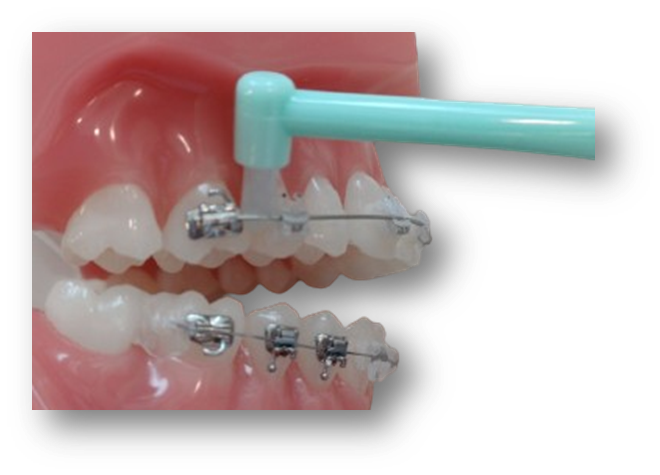 첨단칫솔사용법