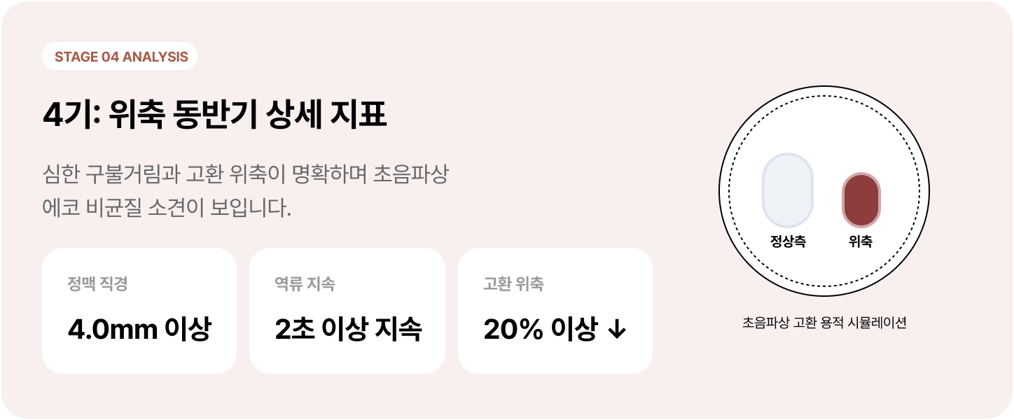 정계정맥류 4기: 위축 동반기 상세 지표 - 심한 구불거림과 고환 위축이 명확하며 초음파상 에코 비균질 소견이 보입니다