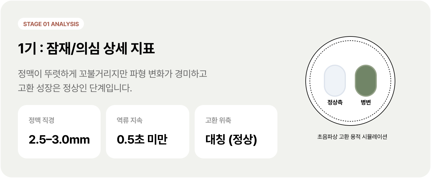 정계정맥류 1기 : 잠재/의심 상세 지표 - 정맥이 뚜렷하게 꼬불거리지만 파형 변화가 경미하고 고환 성장은 정상인 단계입니다.