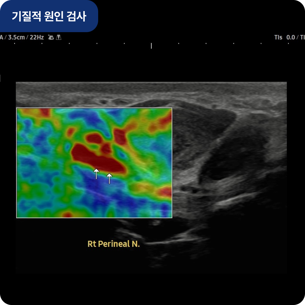남성 배뇨장애 기질적 원인 검사 - 회음신경 검사