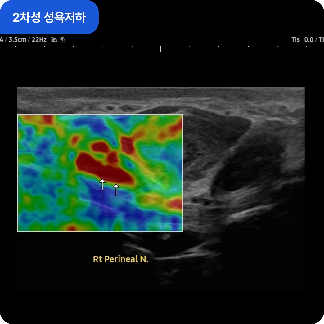 2차성 성욕저하 회음신경 검사