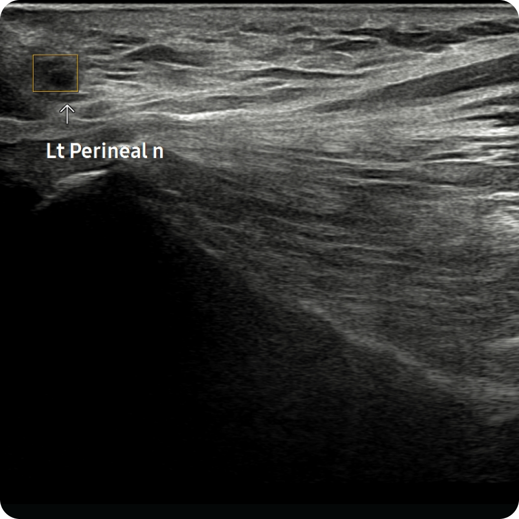 이온한의원 회음부 통증 클리닉 - 초음파 검사