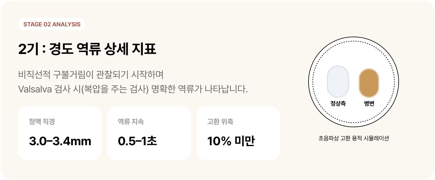 정계정맥류 2기 : 경도 역류 상세 지표 -비직선적 구불거림이 관찰되기 시작하며 Valsalva 검사 시(복압을 주는 검사) 명확한 역류가 나타납니다.