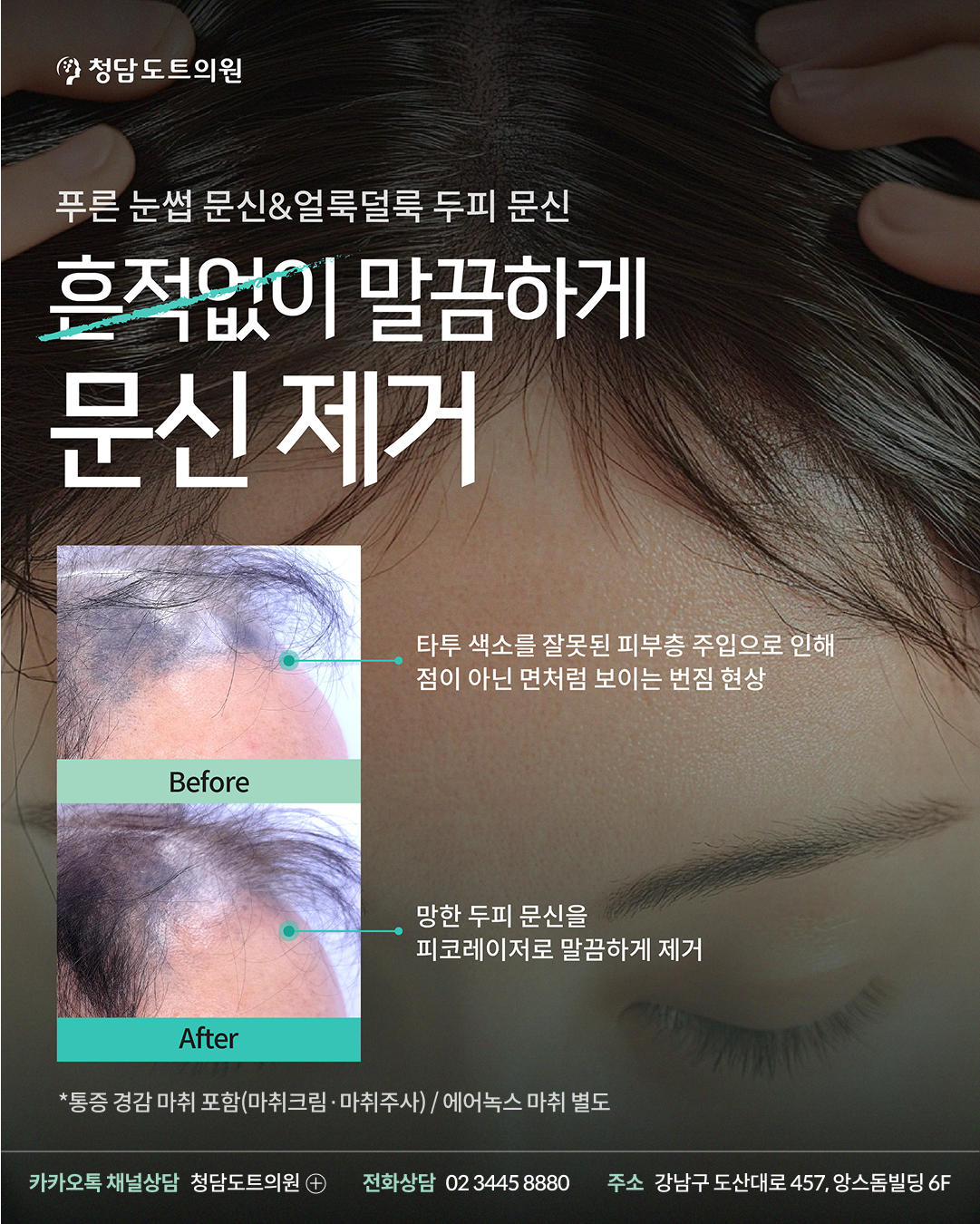 청담도트의원 문신 타투 제거