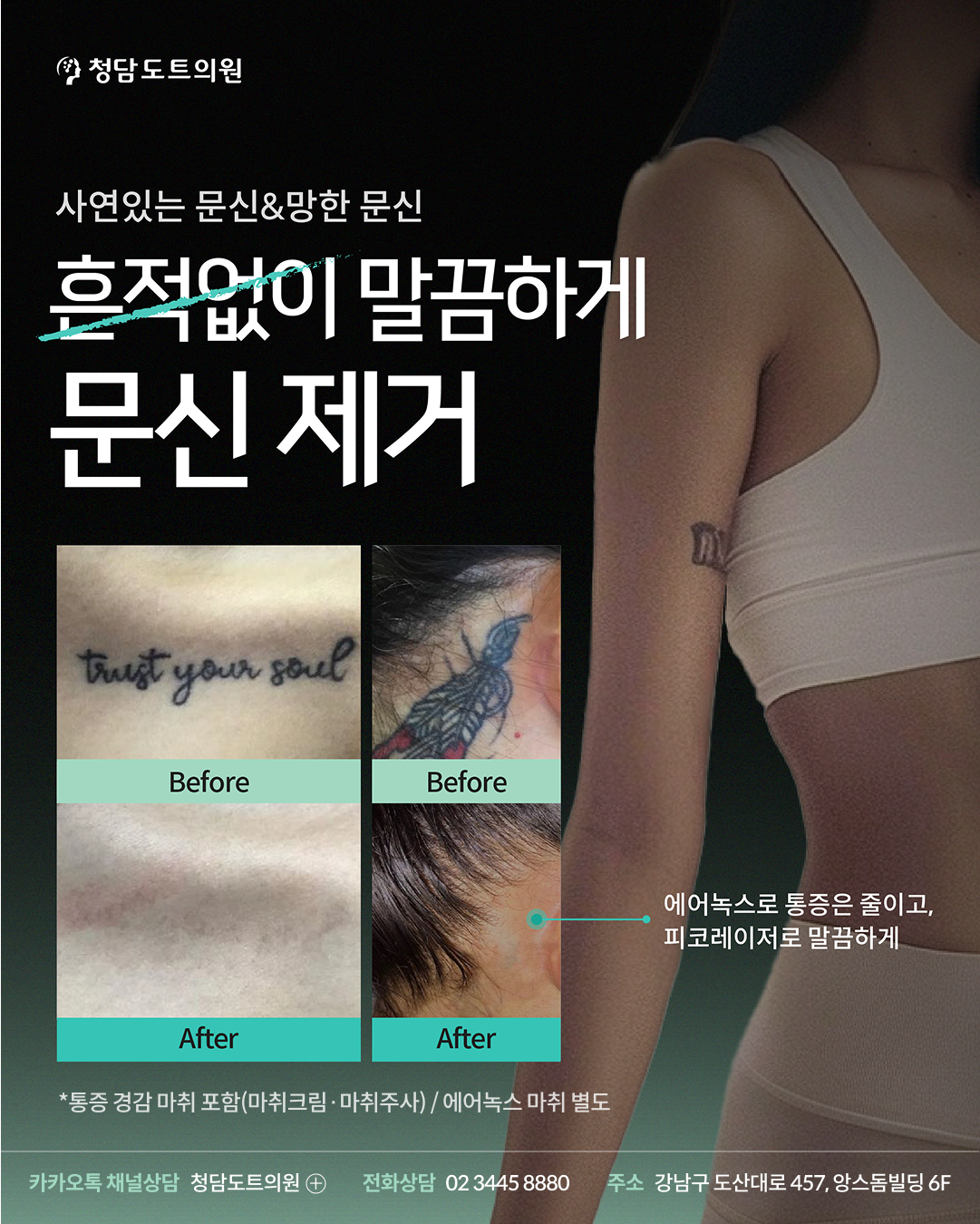 청담도트의원 문신 제거