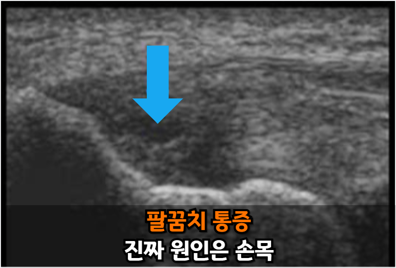 팔꿈치 통증