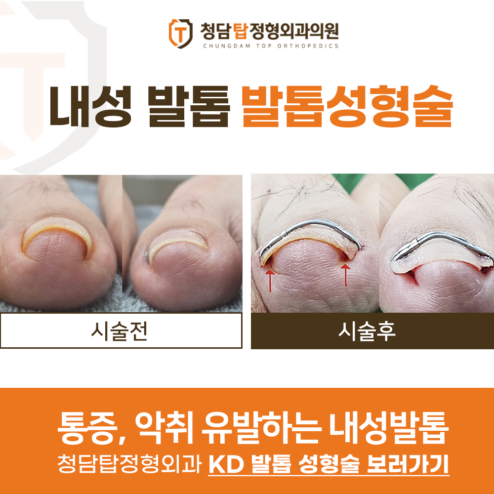 발톱성형술