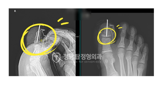 성장판골절 치료