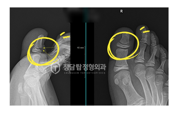 성장판골절