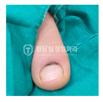 어린이골절