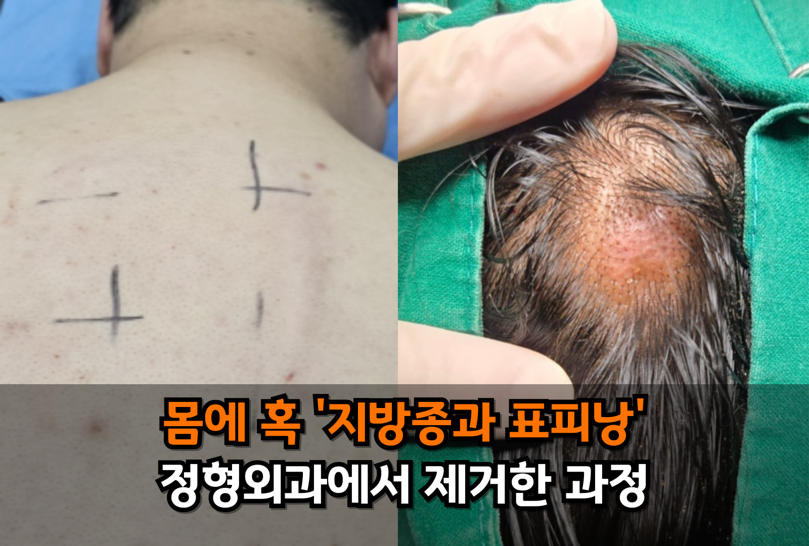 몸에 혹 빼야하는 경우