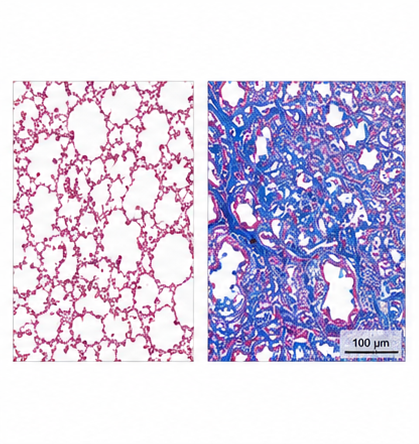 Masson's Trichrome collagen 침착 결과 예시
