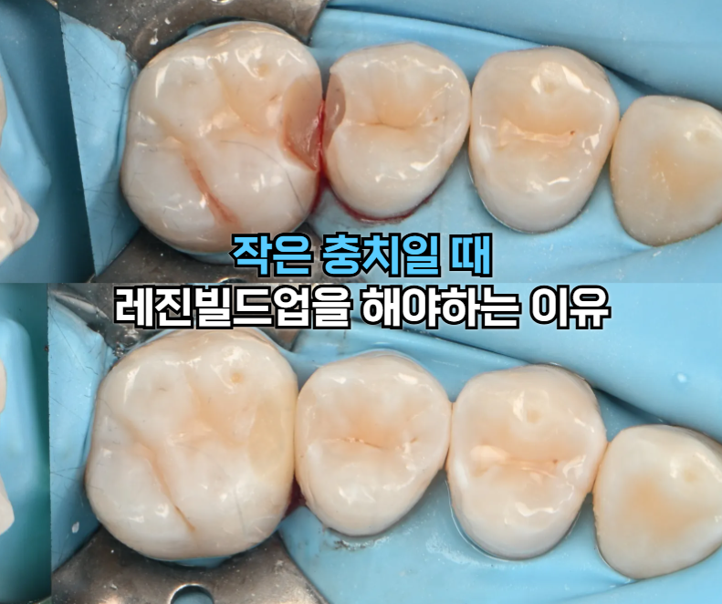 어금니까만점 작은충치 삭제 후 레진빌드업 치료전후 사진