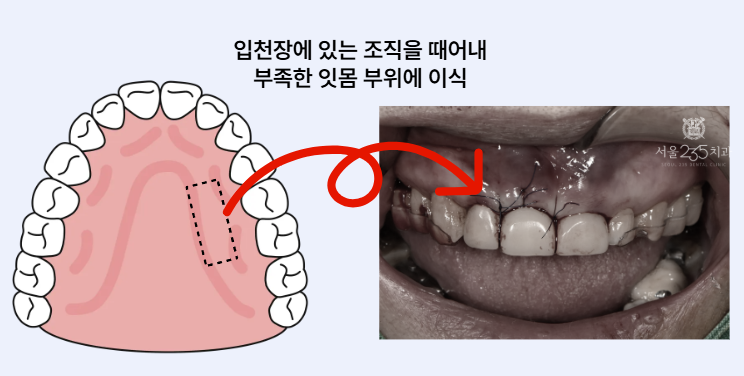 잇몸이식술 설명