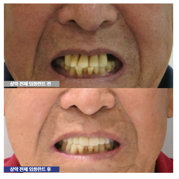 상악 전체임플란트 수술 전후 사진