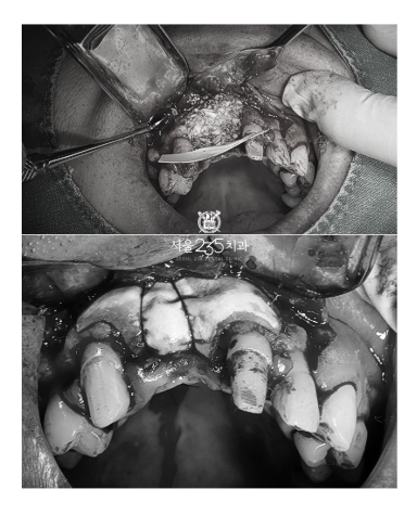 잇몸 뼈이식