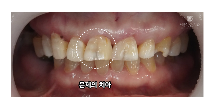 앞니 치아균열