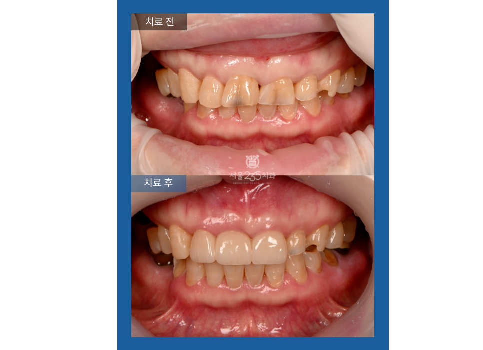 앞니브릿지치료결과