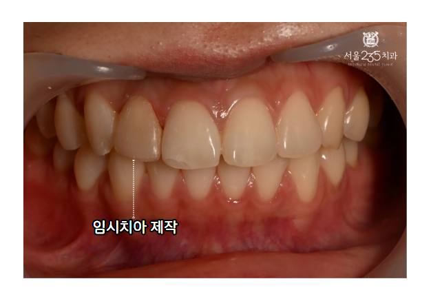앞니부러짐 임시치아