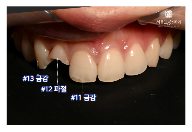앞니부러짐