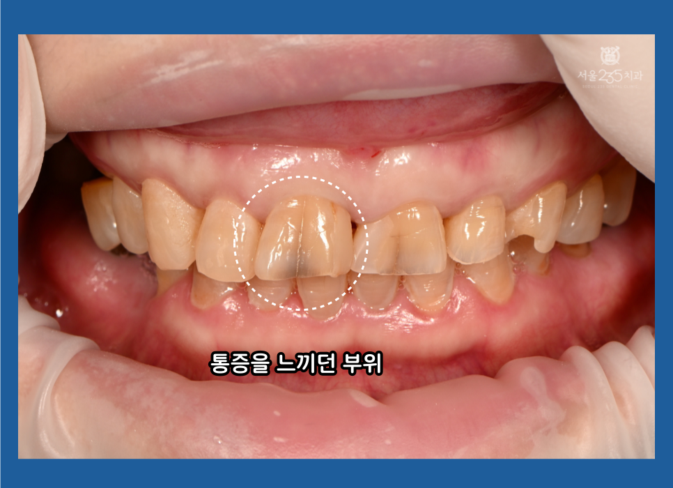 치아균열로 인해 앞니 통증을 느꼈던 환자사진