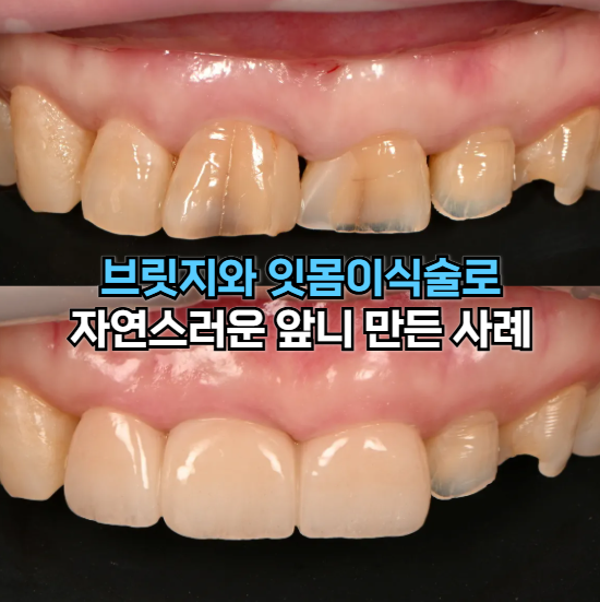 앞니실금 발치, 앞니브릿지치료전후사진