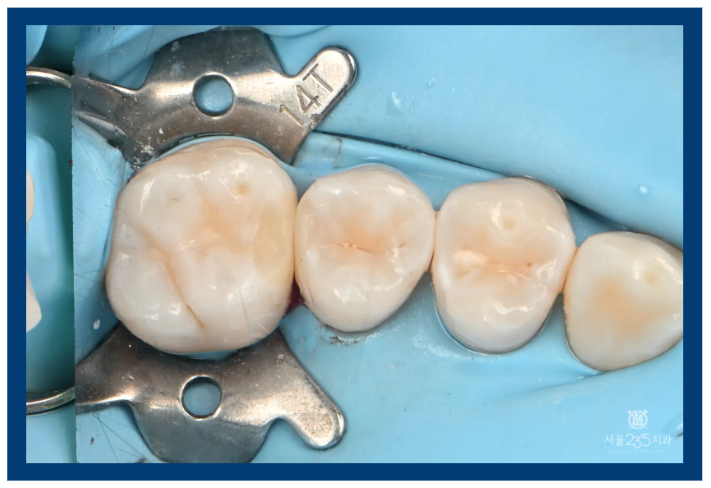 레진빌드업 결과